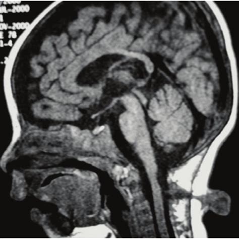 Cervical sagittal T1 weighted MRI shows cervical myelomeningocele at ...