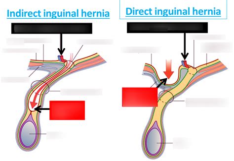 Indirect Inguinal Hernia Female