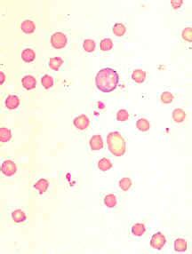 diapo12-anisocytosis