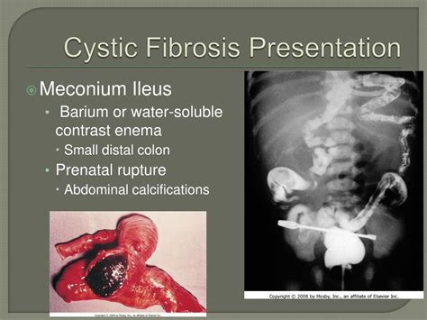 Ppt Cystic Fibrosis Powerpoint Presentation Free Download Id762546