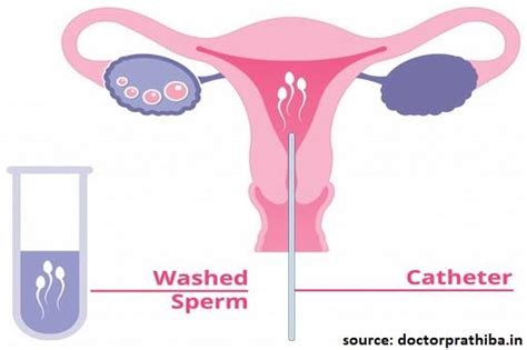 What Is The Difference Between Iui And Ivf Nisha Ivf