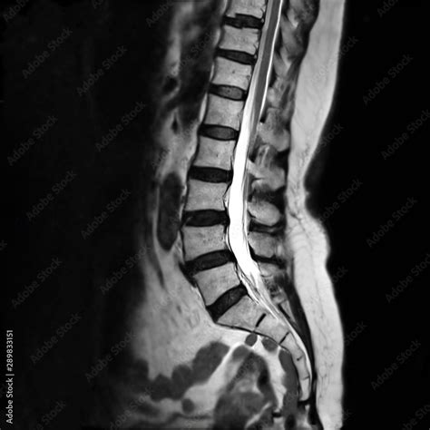 Mri L S Spine Or Mri Of Lambosacral Spine Or L S Spine On Sagittal