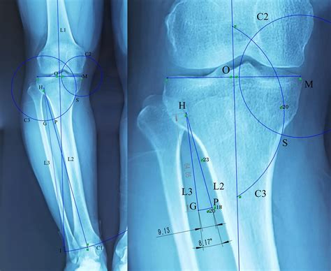 Frontiers Application Of Solidworks Software In Preoperative Planning