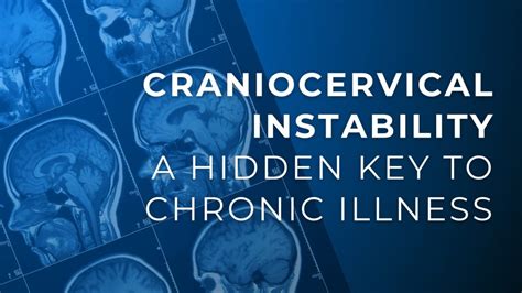 Craniocervical Instability A Hidden Key To Chronic Illness Dr Eric