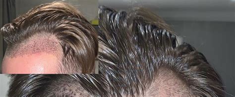 how long do hair transplants take to heal