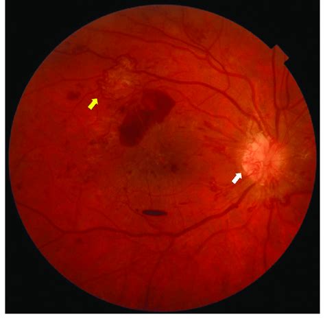 Proliferative Diabetic Retinopathy The Retina Shows Proliferative Download Scientific Diagram