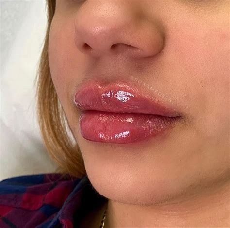 Girl Lip Fillers Hot Sex Picture