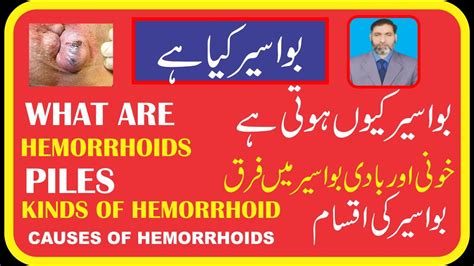 What Are Hemorrhoids Piles Bawaseer Types Of Hemorrhoid S And Its