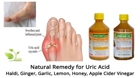 Gout Treatment How To Cure Gout Naturally And How To Cure Uric Acid Permanently Health 24h