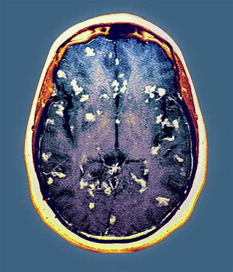 Diseased Brain Photograph By Zephyr Science Photo Library Fine Art