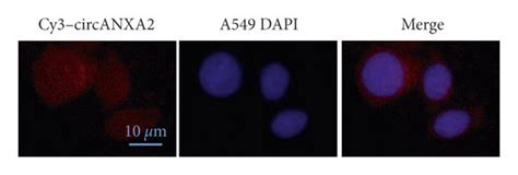 Circanxa Is Upregulated In Lung Cancer Tissues And Is Related To The