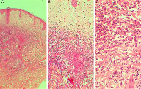 A And B Subepidermal Edema Associated With An Inflammatory Infiltrate Download Scientific