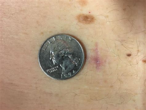 Microdiscectomy Scar