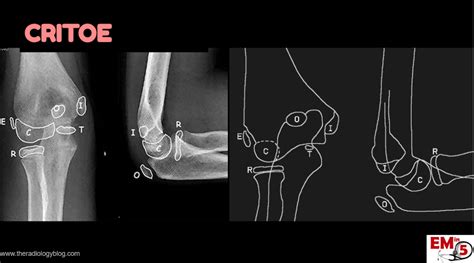 emDOCs.net – Emergency Medicine EducationEM in 5: Elbow Xrays - emDOCs ...