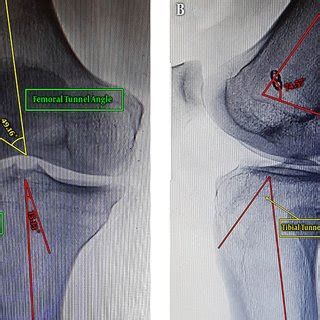 PTS Posterior Tibial Shelf The Slope Where The PCL Tibial