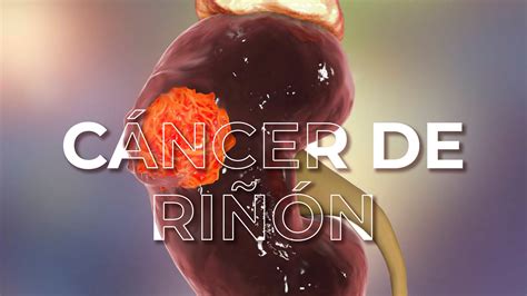 Cáncer de Riñón Clínica de Alta Especialidad