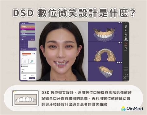 陶瓷貼片怎麼貼更美？伍從心醫師用dsd數位微笑設計讓你的微笑更加分 Pinmed