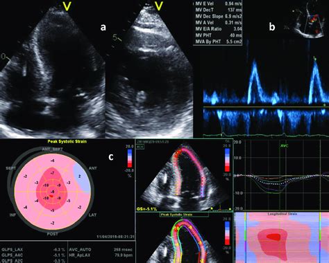 Transthoracic Echocardiogram A Longitudinal Axis And Short Axis