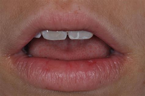 Patient Instructions For A Lips At Rest Photo Lee Ann Brady Dmd S