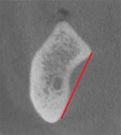 Presence Of Lingual Concavity As Shown In A Crosssectional CBCT Image