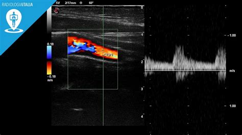 Ecodoppler Degli Arti Inferiori A Cosa Serve E Cosa Vede Radiologia