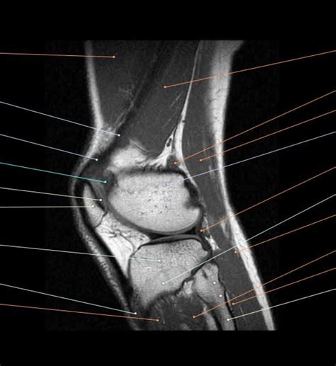 Axial Knee Mri Diagram Quizlet