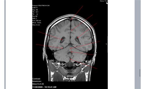 CT scan Brain pt 2 slice 7 Diagram | Quizlet