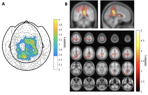 A. Maps of MEG sensors where the expectation parameter η t ...