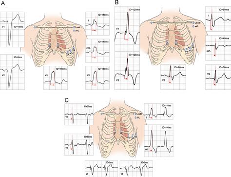 Delayed Intrinsicoid Deflection Onset In Surface Ecg Lateral Leads