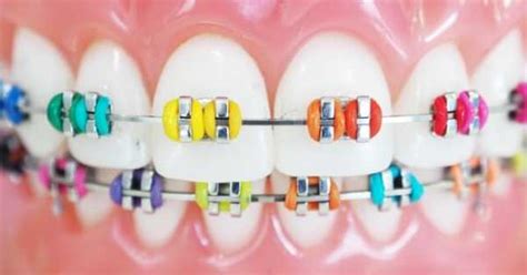 How To Know What Braces Color Is Best To Pick Ismile