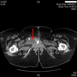 Sagittal Reconstruction Of Computed Tomography Performed Eight Months