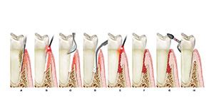 Laser Assisted Periodontal Regeneration With The LANAP Protocol