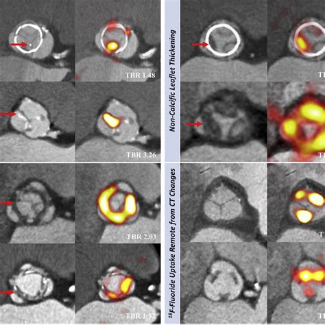 Ex Vivo Degenerated Bioprosthetic Aortic Valves Macroscopic