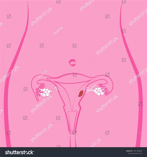 Uterine Fibroid Vector Illustration Stock Vector Royalty Free