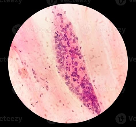 Microscopic View Of Trichomonas Vaginalis In Pap Smear With Few Acute