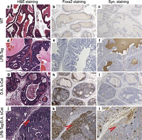 Compound Activation Of Sv40 Large T Antigen And β Catenin Causes