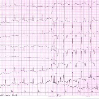 Twelve Lead Electrocardiogram Sinus Rhythm And Deep Inverted T Waves In