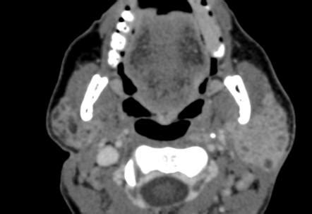 Benign Lymphoepithelial Lesions Radiology Reference Article