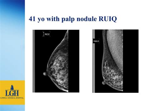 Ppt Breast Mri At Lowell General Hospital Powerpoint Presentation