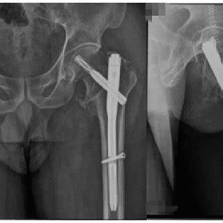 (A) Preoperative X-ray showing intertrochanteric fracture. (B ...