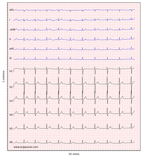 Abnormal Ecg Examples