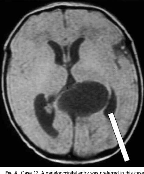 Figure 4 From Neuroendoscopic Treatment Of Arachnoid Cysts Of The