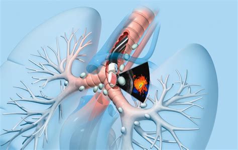 Endobronchial Ultrasound EBUS Bronchoscopy Procedure Temecula