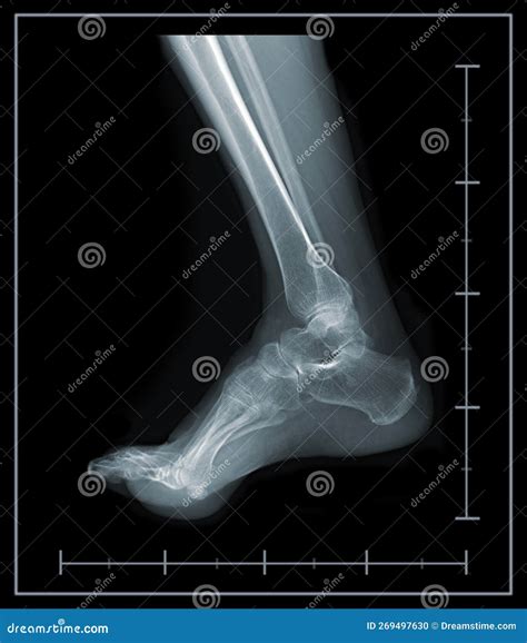 X-ray Foot and Ankle Lateral View. Stock Photo - Image of skeleton ...