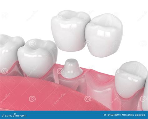 3d Render Of Jaw With Dental Cantilever Bridge Stock Photo