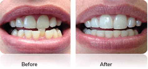 Accelerated Orthodontics And Teeth Straightening Options Acceledontics