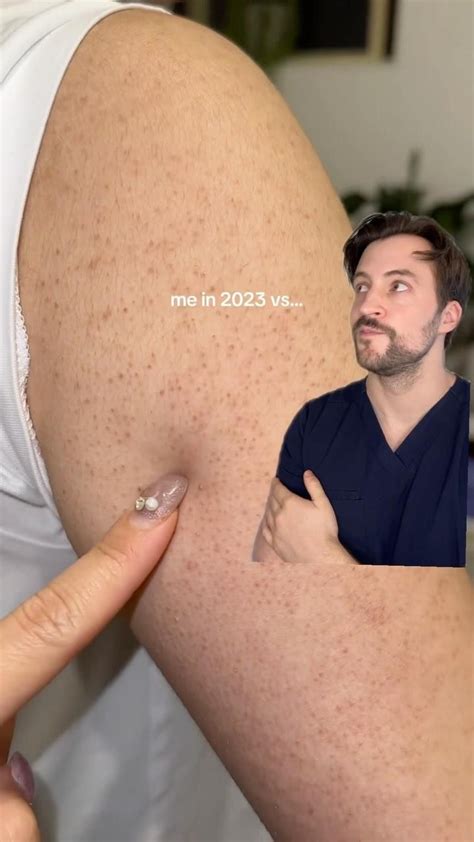 Best 13 How To Prevent Razor Bumps Ingrown Hairs On Bikini Area Artofit