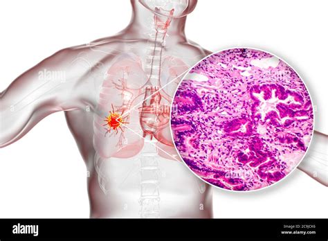 Lung Cancer Computer Illustration And Light Micrograph Light