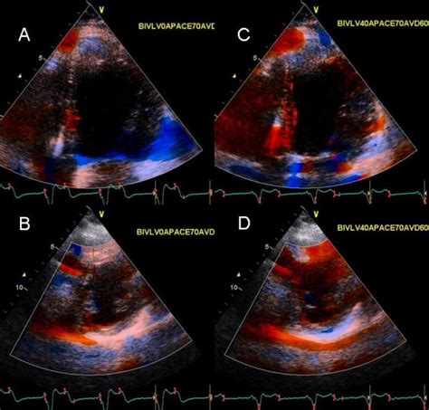 Tissue Doppler Strain Images In The Apical Top Panels And