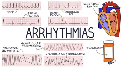 Understanding Arrhythmias Youtube